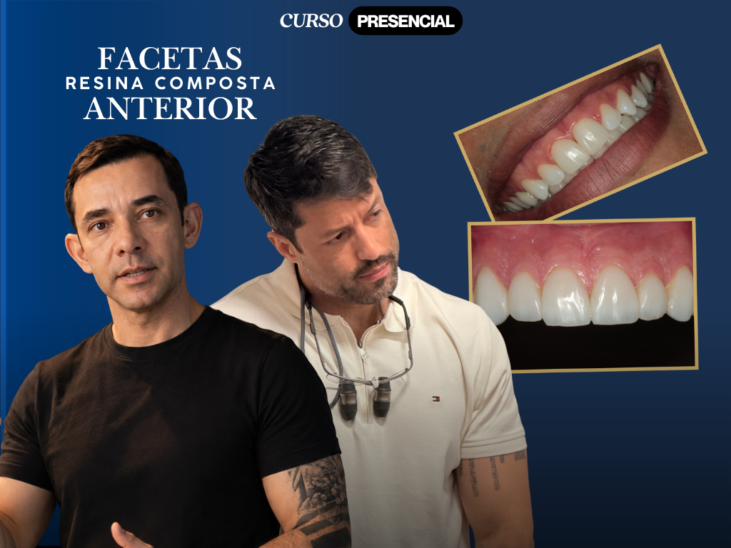 Curso Facetas em Resina Composta Anterior